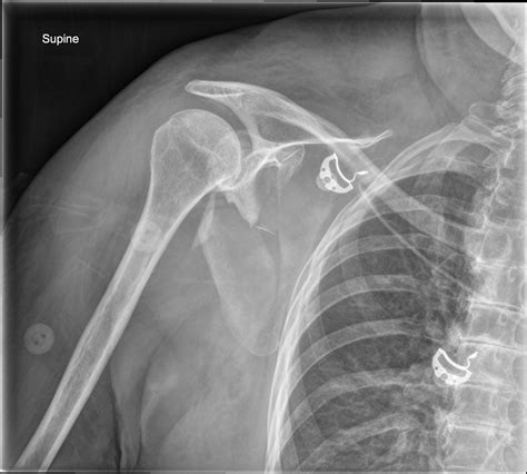 metal brackets on left scapula|scapula fracture non surgical.